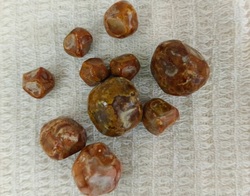 Хирурги достали 10 крупных камней из желчного пузыря любителя чипсов