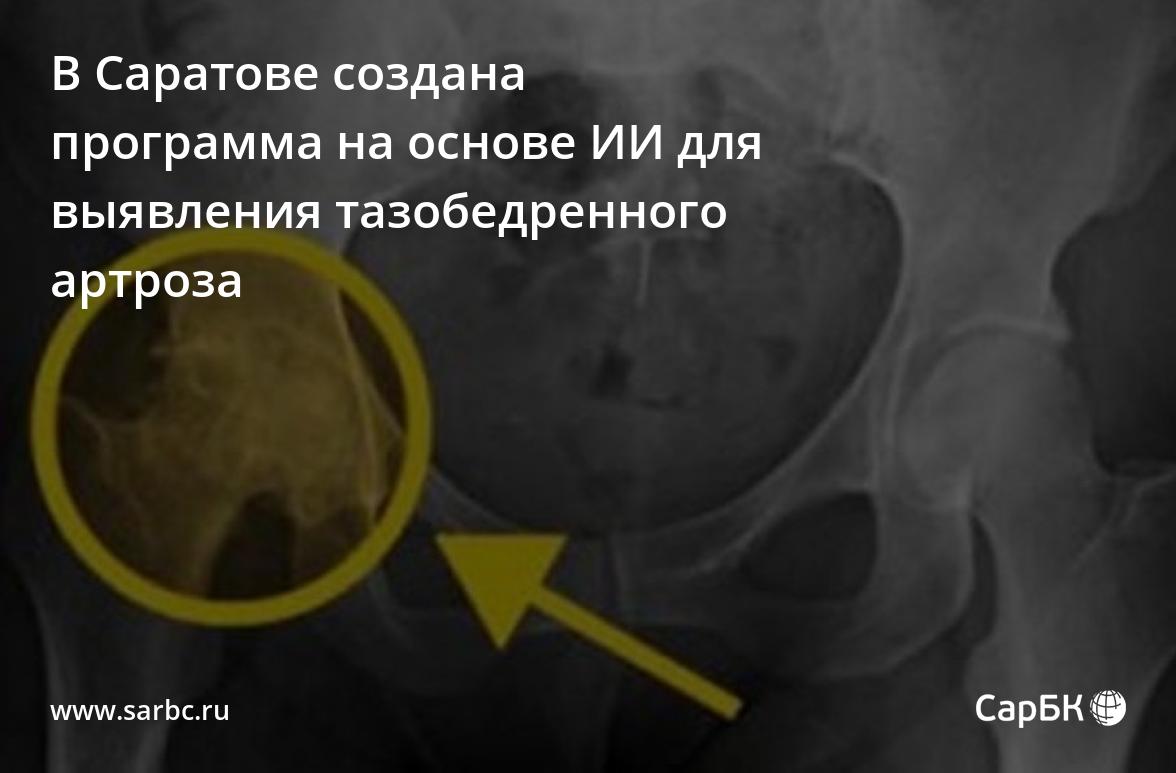 В Саратове создана программа на основе ИИ для выявления тазобедренного  артроза