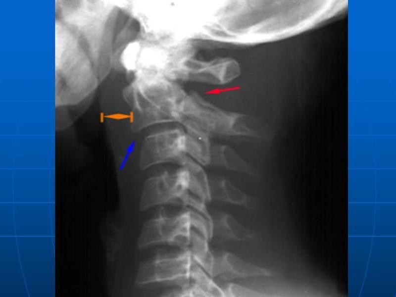На вечеринке студентка из-за ревности сломала девушке позвоночник